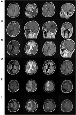 Case Report: Moving Tumor-Like Foci Behind Refractory Epilepsy-Cerebral Sparganosis Successfully Treated by Surgery After Failure of Praziquantel Treatment